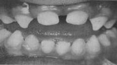 При една рядка генетична болест кучешките зъби добиват конична форма и силно израстват